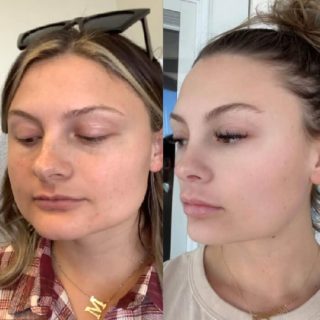 masseter botox before and after women