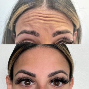 forehead-2