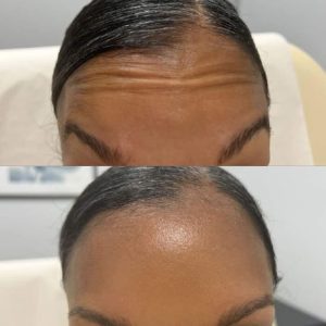 forehead-3