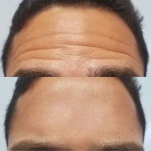 forehead-4