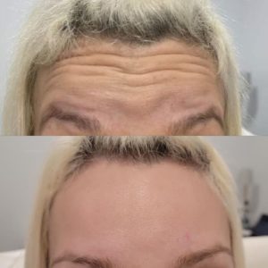 forehead-5