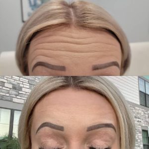 forehead-6