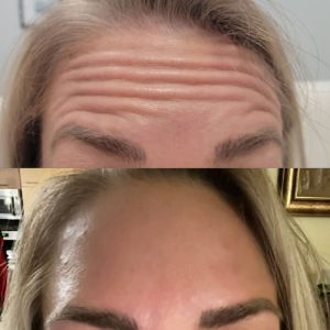 forehead-7