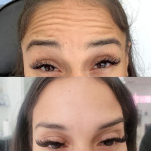 forehead-8