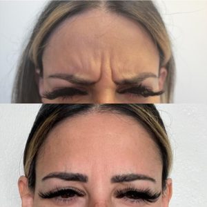 glabella-3