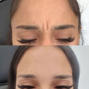 glabella-6