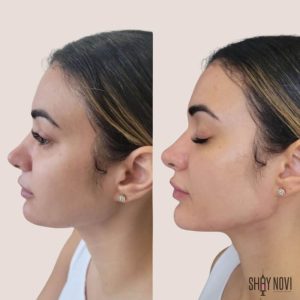 jawline-chin-1
