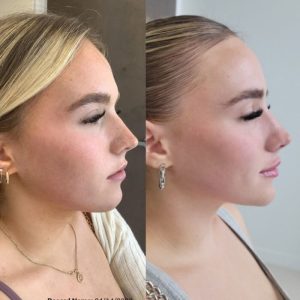 jawline-chin-10