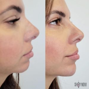 jawline-chin-12