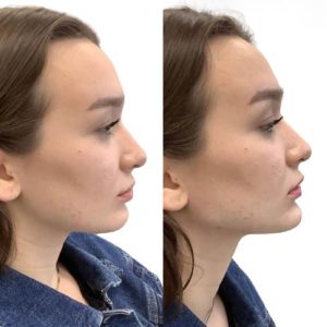 jawline-chin-14