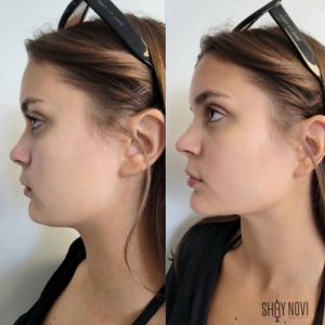 jawline-chin-16