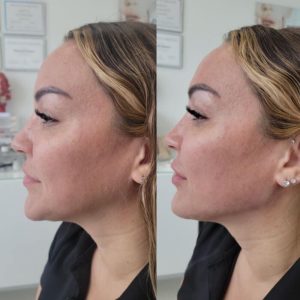 jawline-chin-18