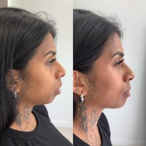 jawline-chin-2