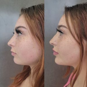 jawline-chin-20