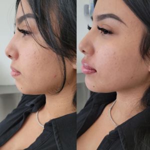 jawline-chin-22