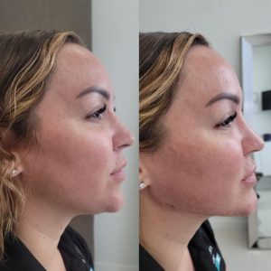 jawline-chin-3