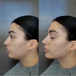 jawline-chin-7
