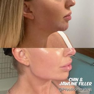 jawline-chin-8