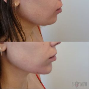 jawline-chin-9