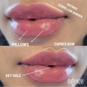 lip-filler-service-1