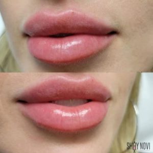 lip-filler-service-2