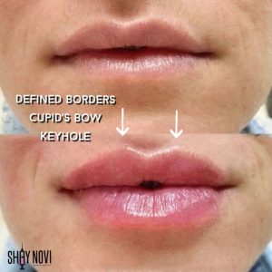 lip-filler-service-3