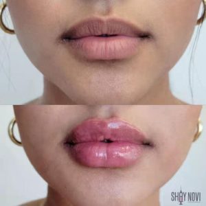 lip-filler-service-4