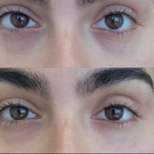 under-eye-filler-1
