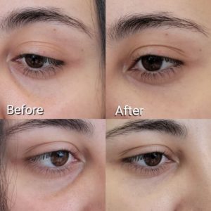 under-eye-filler-2