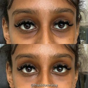under-eye-filler-3