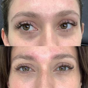 under-eye-filler-4