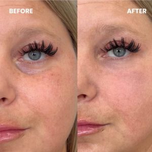 under-eye-filler-5