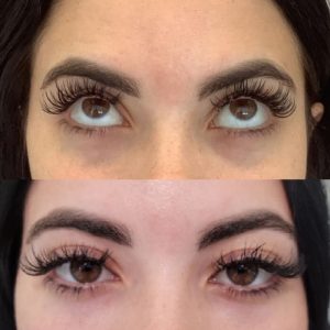 under-eye-filler-6