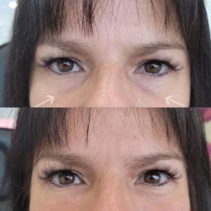 under-eye-filler-7