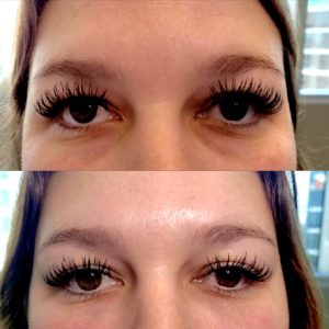 under-eye-filler-8