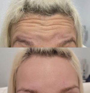 forehead-ideal