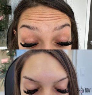 botox-1