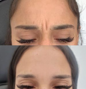 botox-3