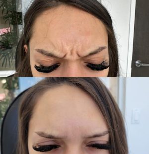 botox-4