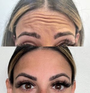 botox-5