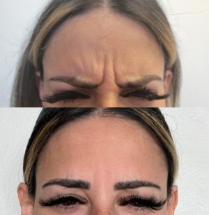 botox-6