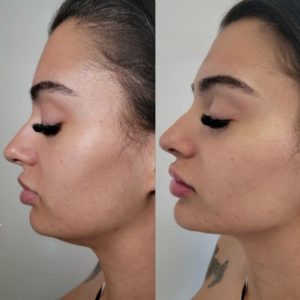 jawline-results-1