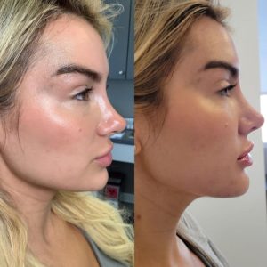 jawline-results-2