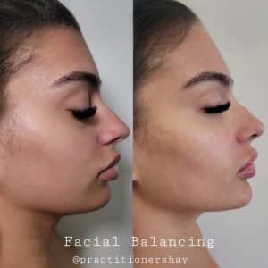 jawline-results-3